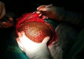 Titanium mesh